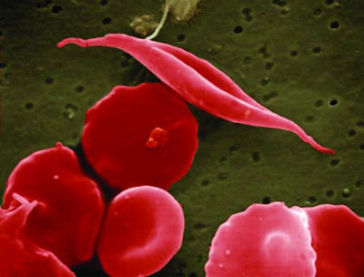 sickle cell close up image