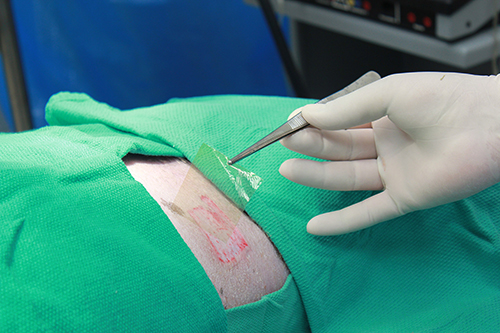 image of surgery and a patients skin area exposed. A doctor is holding up a small clear film sheet with tweezers