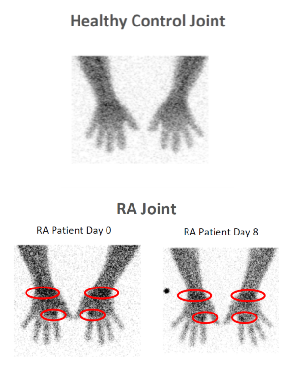 Healthy and RA joint image