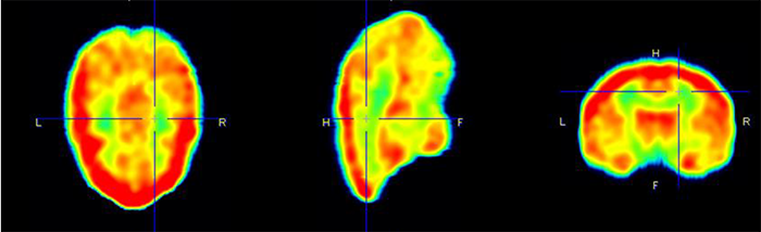 A monkey brain PET image showing the target areas for Tetra’s therapeutic