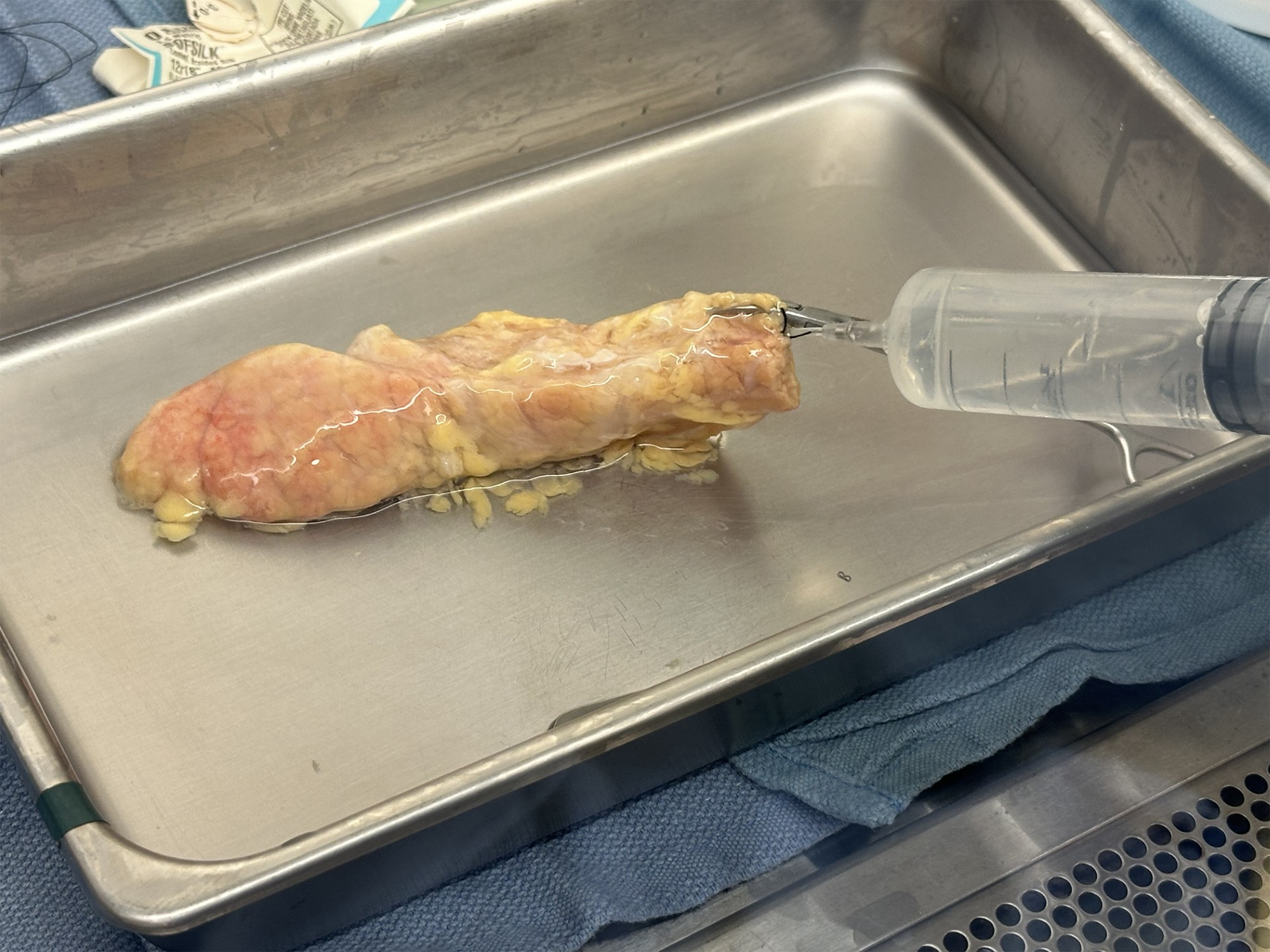 A donor pancreas on a stainless steel surgical tray receiving an injection of enzyme solution via syringe