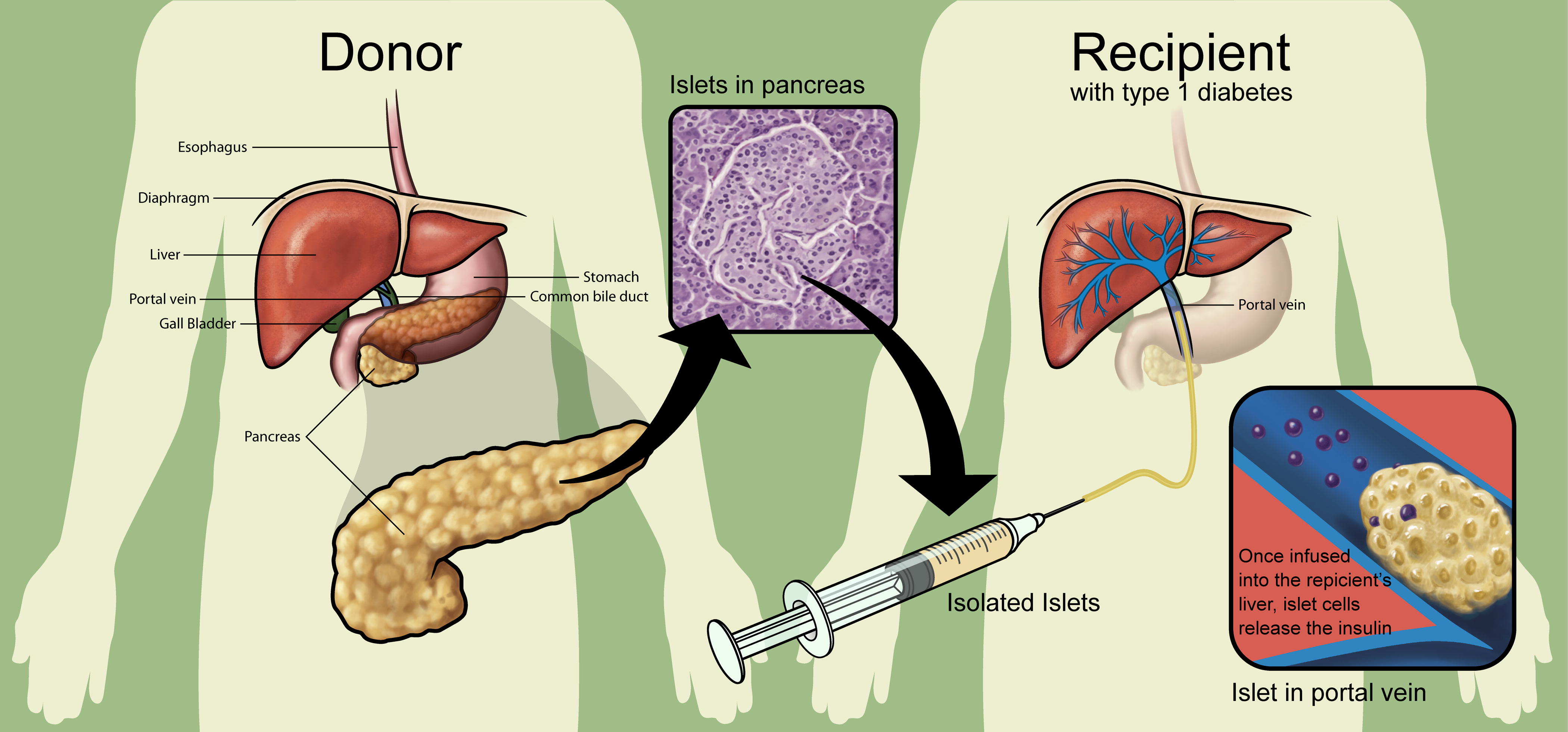 An anatomical diagram illustrating the clinical islet transplantation process in three stages. On the left, a labeled donor torso shows the pancreas, liver, gallbladder, portal vein, stomach, common bile duct, esophagus, and diaphragm. A microscopic inset at the top center shows a magnified view of islets within the pancreas. In the center bottom, a syringe labeled Isolated Islets represents the extracted islet cells. On the right, a recipient torso with type 1 diabetes shows the liver and portal vein; a bottom-right inset depicts an islet cell lodged in the portal vein with the caption Once infused into the recipient's liver, islet cells release the insulin.