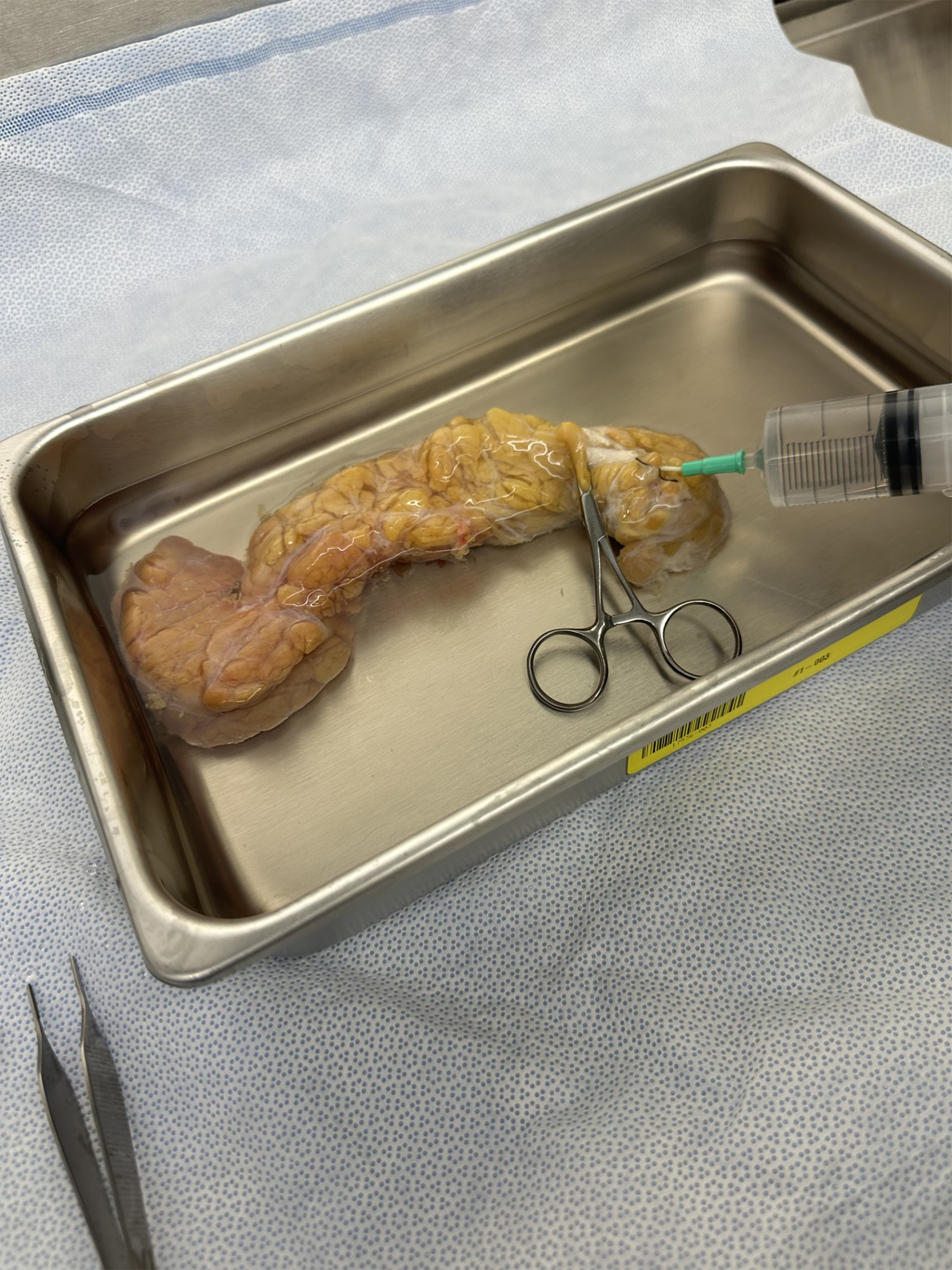 A donor pancreas in a stainless steel surgical tray being infused with enzyme solution via syringe, with a hemostat clamp positioned on the organ to control flow during the islet isolation procedure.